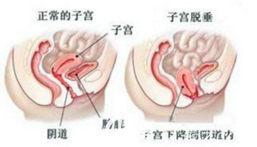 正常的子宫和子宫下垂示意图