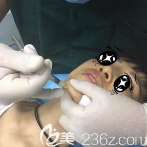 杜凯娟主任帮我注射伊婉玻尿酸术中即刻 杜凯娟主任帮我注射伊婉玻尿酸术中即刻