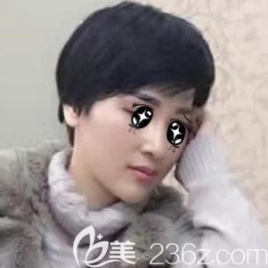 注射伊婉玻尿酸垫下巴术后25天下巴自然 注射伊婉玻尿酸垫下巴术后25天下巴自然