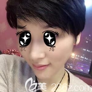 到太原时光做玻尿酸垫下巴术后45天恢复效果 到太原时光做玻尿酸垫下巴术后45天恢复效果