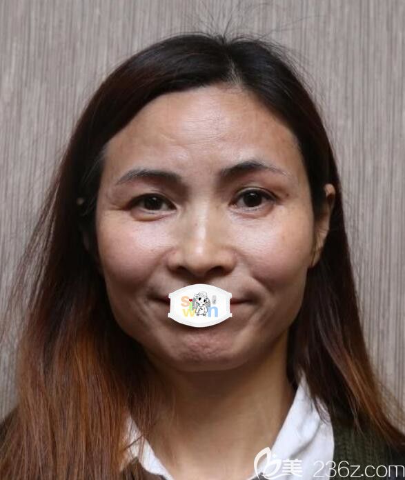 孝感天妃自体脂肪面部填充真人案例 孝感天妃自体脂肪面部填充真人案例