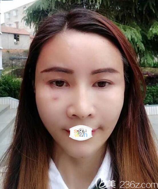 孝感天妃柳肖全脸脂肪填充术后第2天 孝感天妃柳肖全脸脂肪填充术后第2天