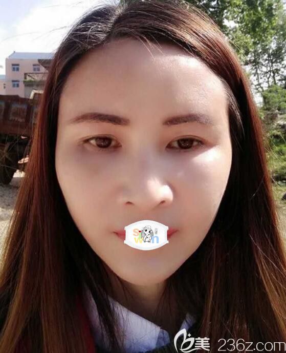 孝感面部年轻化哪家好?天妃脂肪丰面案例 孝感面部年轻化哪家好?天妃脂肪丰面案例