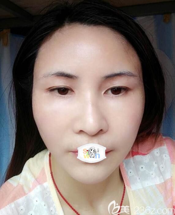 孝感整形哪里比较好？花1W多价格找孝感天妃柳肖做自体脂肪面部填充术后11天恢复自然