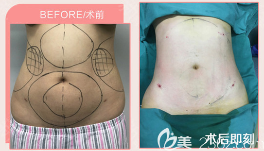 广州南珠整形程明医生做的腰腹部吸脂案例