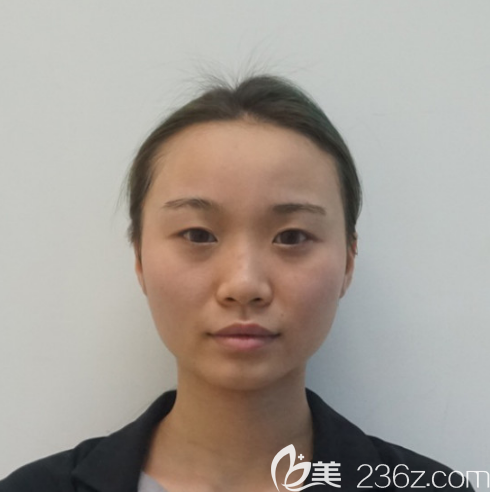 术前单眼皮照片 术前单眼皮照片