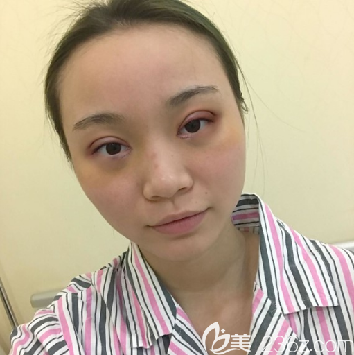 广州余花医生双眼皮术后7天效果图 广州余花医生双眼皮术后7天效果图