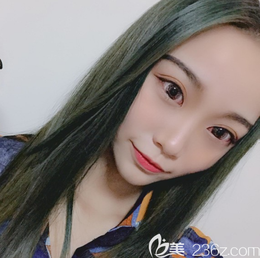 广州爱来整形医院余花双眼皮案例一个月效果 广州爱来整形医院余花双眼皮案例一个月效果