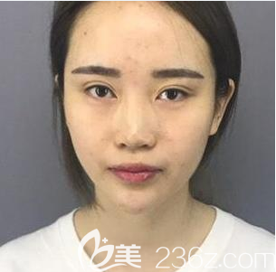 找广州爱来整形余花做隆鼻术前照片 找广州爱来整形余花做隆鼻术前照片