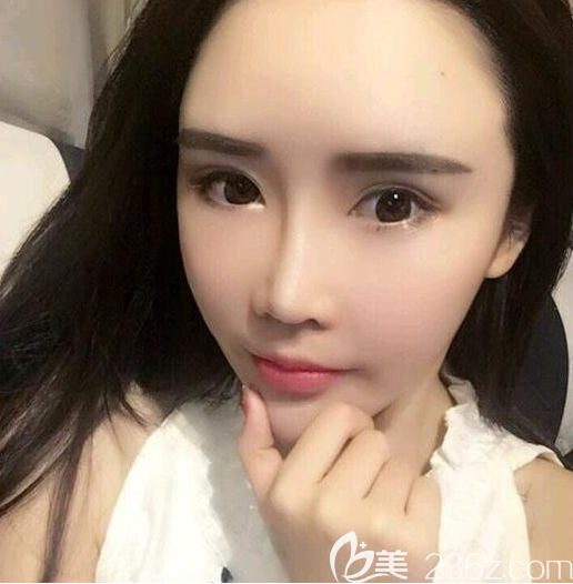 鼓气勇气找广州爱来整形医院余花医生做了隆鼻和面部自体脂肪填充