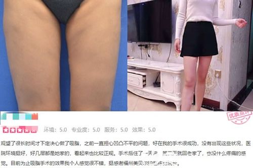 福州美贝尔赵栋材医生吸脂瘦大腿真人案例效果图