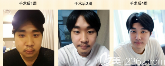 闵龙奎术后4周的变化情况 闵龙奎术后4周的变化情况