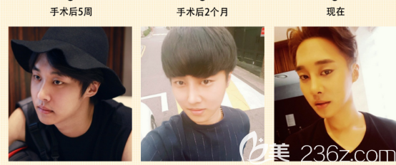 闵龙奎术后两个月的变化情况 闵龙奎术后两个月的变化情况