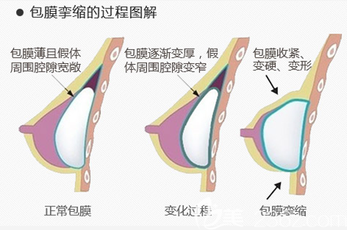 包膜挛缩是如何形成的