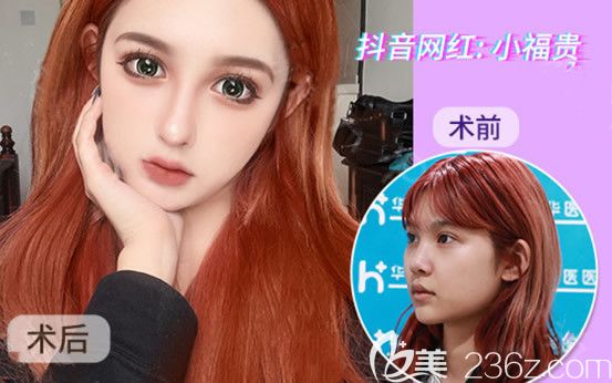 呼和浩特华医整形半肋软骨隆鼻和膨体隆鼻20天效果