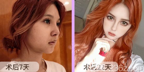 半肋软骨鼻综合第7天和22天效果