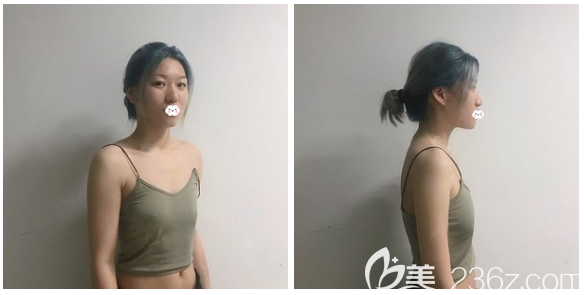 东莞华美医疗美容整形门诊部詹慧术前照片1