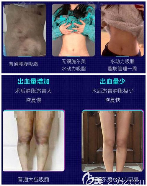 无锡施尔美吸脂效果