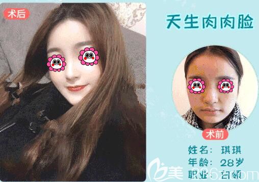 <!--<i data=20240703-sp></i>-->面部吸脂案例