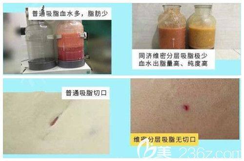 无锡同舟吸脂优势公开
