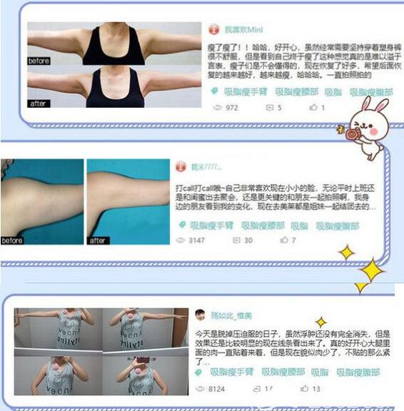 无锡爱思特吸脂评价