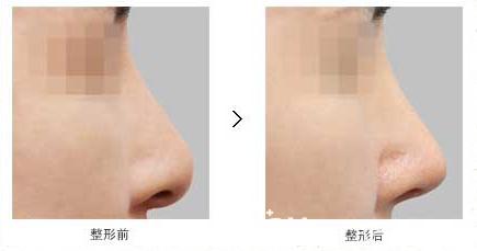 韩国原辰鼻头变形修复真人案例