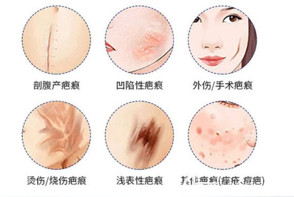 哪些疤痕可以用激光来去除