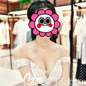 杭州艺星假体隆胸术后十天<span style=