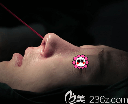 刘彦军医生给我做鼻修复术后即刻照