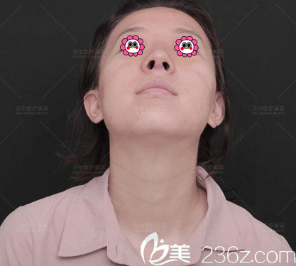 我找北京沃尔刘彦军医生做鼻综合修复第7天样子