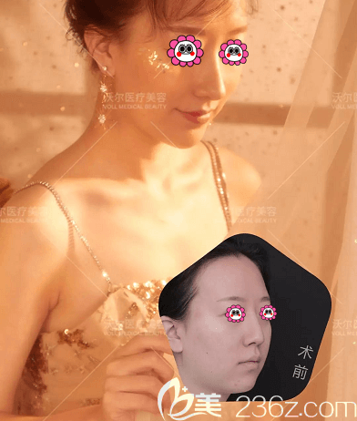 北京鼻综合修复哪个医院好？我找北京沃尔刘彦军做鼻综合修复<span style=