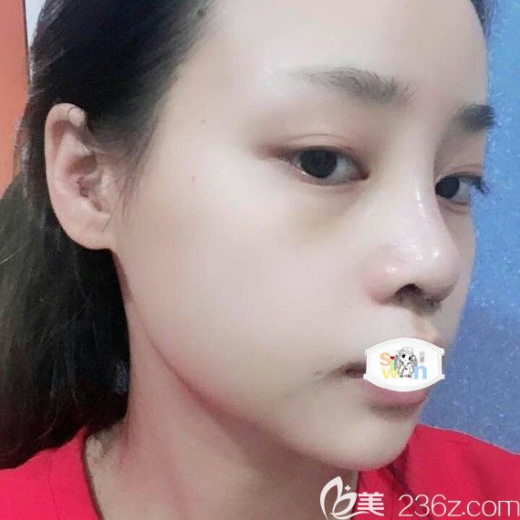 孝感天妃柳肖隆鼻术后7天恢复照片