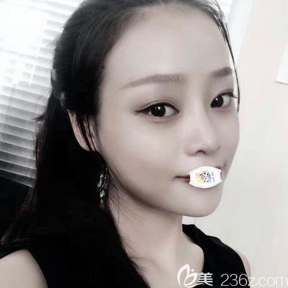 孝感天妃柳肖鼻综合隆鼻1个月恢复图