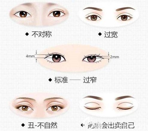 双眼皮失败常见的情况 双眼皮失败常见的情况