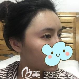 张国军主任帮我做自体脂肪丰额头15天后肿胀渐消