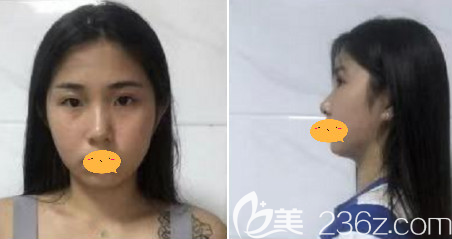 术前的我 术前的我