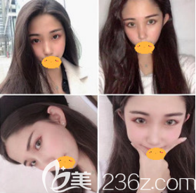 我用面部自体脂肪填充日记告诉你西安叶子整形医院到底正规靠谱吗？