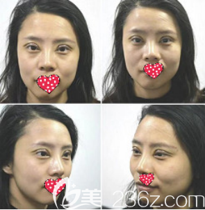 术后一周 术后一周