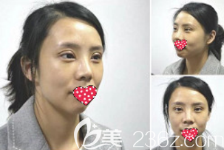 术后15天 术后15天