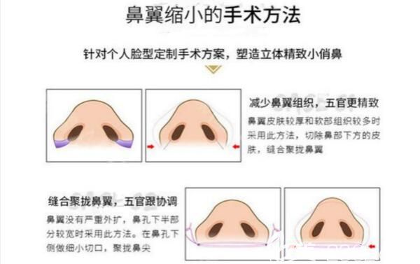 鼻翼缩小手术方法介绍