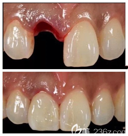 30多岁门牙意外折断顾客在佳美种牙案对比图 30多岁门牙意外折断顾客在佳美种牙案对比图