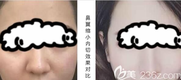 我做鼻翼缩小内切2个月效果对比