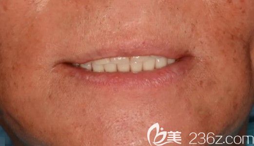 60岁老人佳美口腔做全口种植牙效果图 60岁老人佳美口腔做全口种植牙效果图