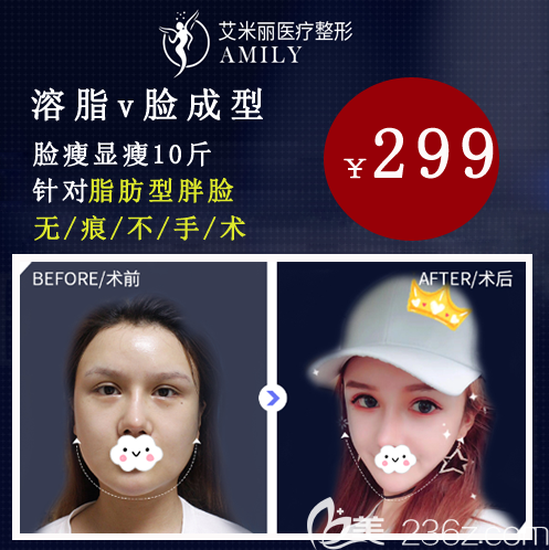 成都艾米丽10周年元起V脸溶脂299元起