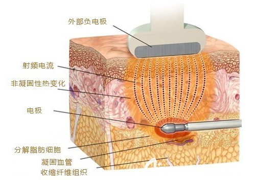 射频溶脂原来示意图