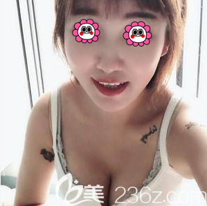 宋延刚医生给我做吸脂丰胸1个月效果 宋延刚医生给我做吸脂丰胸1个月效果