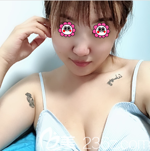 北京美莱宋延刚自体脂肪丰胸案例 北京美莱宋延刚自体脂肪丰胸案例