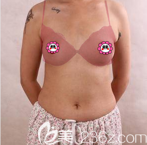 我在北京美莱做自体脂肪丰胸前样子 我在北京美莱做自体脂肪丰胸前样子