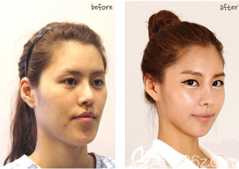 韩国face-line整形医院李真秀智能双鄂手术+V脸雕刻术真人案例对比图