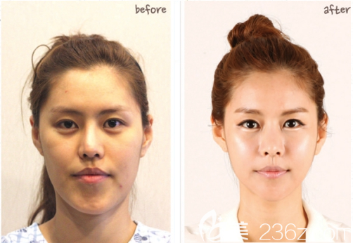 韩国face-line整形医院李真秀智能双鄂手术+V脸雕刻术真人案例正面对比图